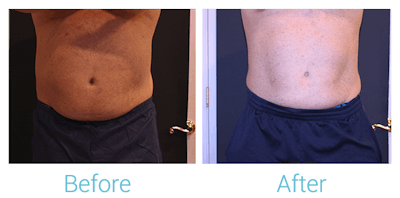 CoolSculpting Before & After Gallery - Patient 58152011 - Image 1