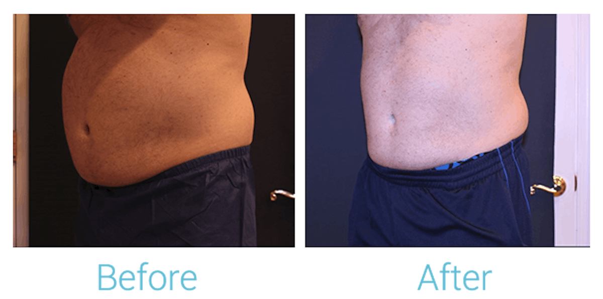 CoolSculpting Before & After Gallery - Patient 58152011 - Image 2