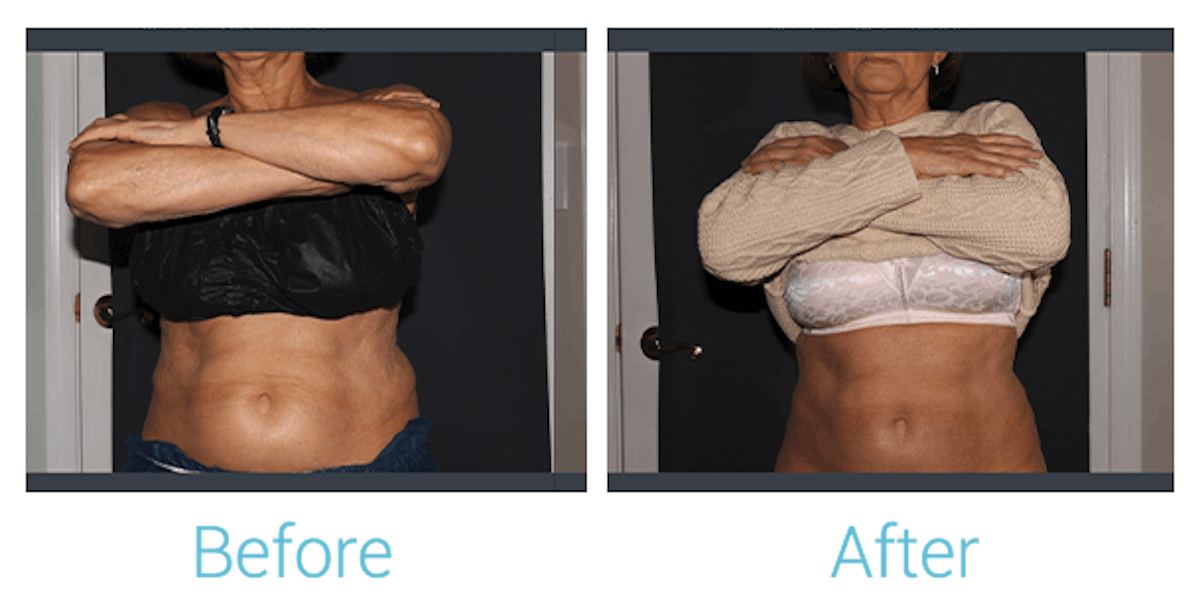 CoolSculpting Before & After Gallery - Patient 58152012 - Image 2