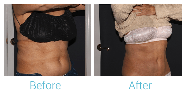 CoolSculpting Before & After Gallery - Patient 58152012 - Image 3