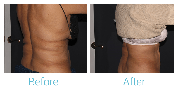 CoolSculpting Before & After Gallery - Patient 58152012 - Image 4