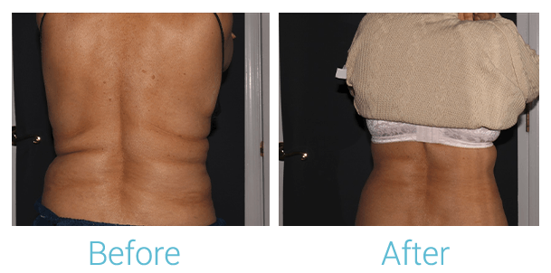 CoolSculpting Before & After Gallery - Patient 58152012 - Image 1
