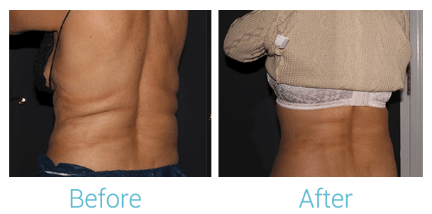 CoolSculpting Before & After Gallery - Patient 58152012 - Image 5
