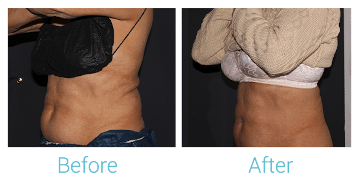 CoolSculpting Before & After Gallery - Patient 58152012 - Image 6