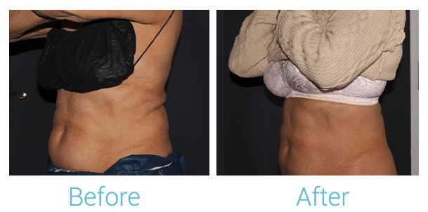 CoolSculpting Before & After Gallery - Patient 58152012 - Image 6