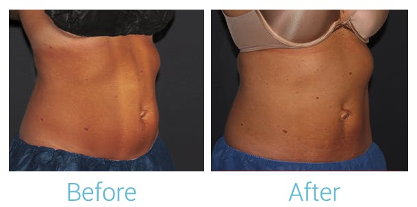 CoolSculpting Before & After Gallery - Patient 58152013 - Image 1