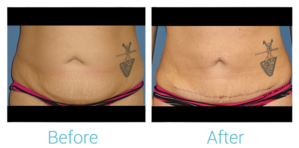 Liposuction