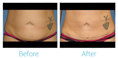 Liposuction Before & After Gallery - Patient 58152019 - Image 1