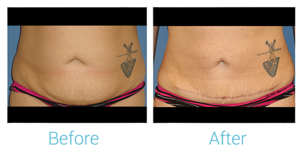 Liposuction Before & After Gallery - Patient 58152019 - Image 1