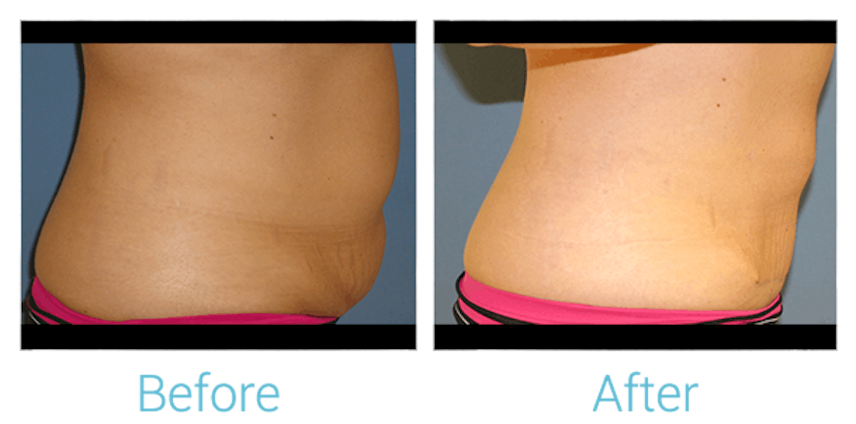Liposuction Before & After Gallery - Patient 58152019 - Image 2