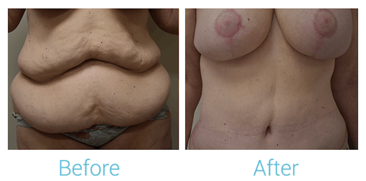 Tummy Tuck Before & After Gallery - Patient 58152086 - Image 1