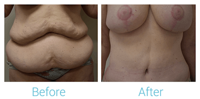 Mommy Makeover Before & After Gallery - Patient 58152026 - Image 1
