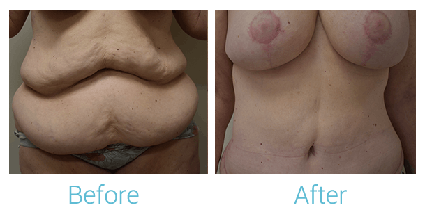 Mommy Makeover Before & After Gallery - Patient 58152026 - Image 1