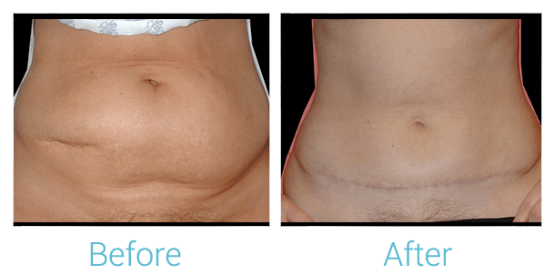 Tummy Tuck Gallery - Patient 58152077 - Image 1