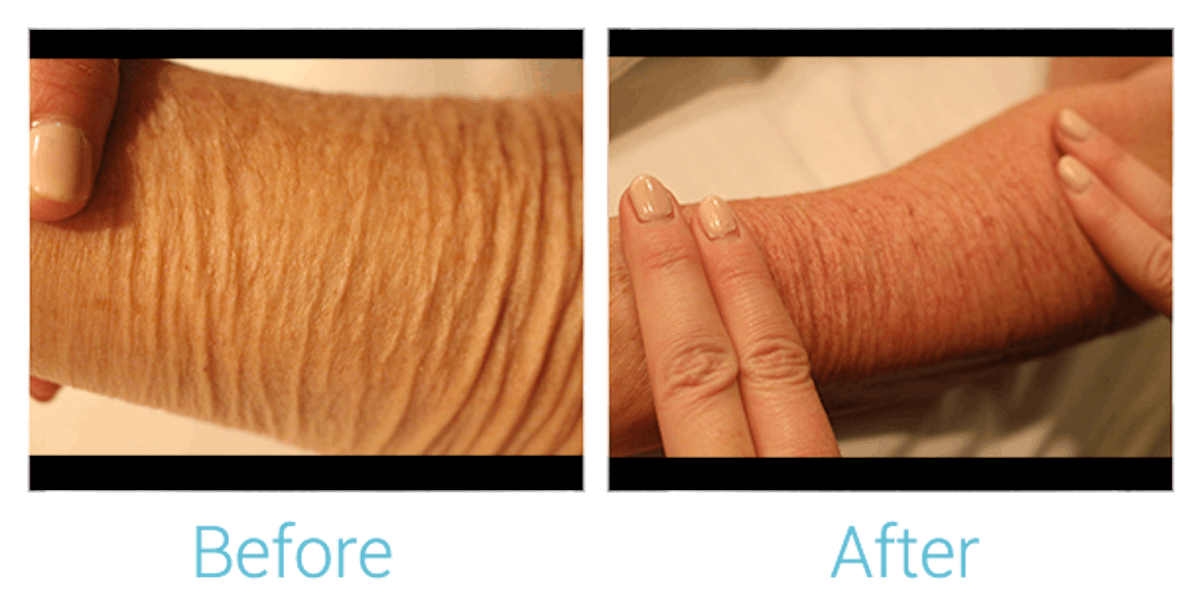 Morpheus8 Before & After Gallery - Patient 58152034 - Image 1