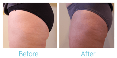 Reaction Radio Frequency Before & After Gallery - Patient 58152035 - Image 1