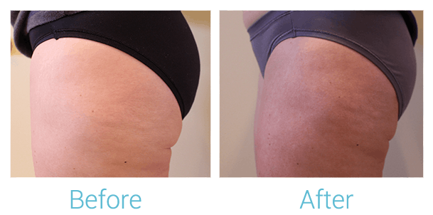 Reaction Radio Frequency Before & After Gallery - Patient 58152035 - Image 1