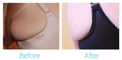 Reaction Radio Frequency Before & After Gallery - Patient 58152036 - Image 1