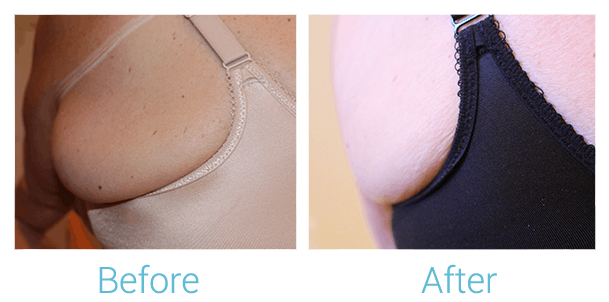 Reaction Radio Frequency Before & After Gallery - Patient 58152036 - Image 1