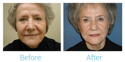 Reaction Radio Frequency Before & After Gallery - Patient 58152037 - Image 1