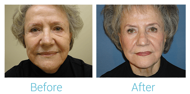 Reaction Radio Frequency Before & After Gallery - Patient 58152037 - Image 1
