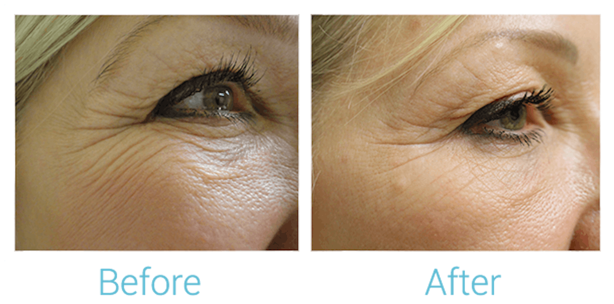 Morpheus8 Before & After Gallery - Patient 58152038 - Image 1
