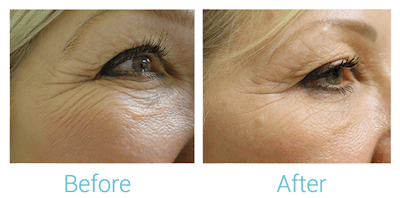 Reaction Radio Frequency Before & After Gallery - Patient 58152038 - Image 1