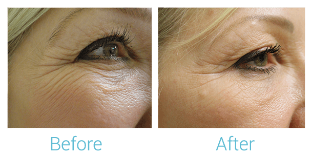Reaction Radio Frequency Before & After Gallery - Patient 58152038 - Image 1
