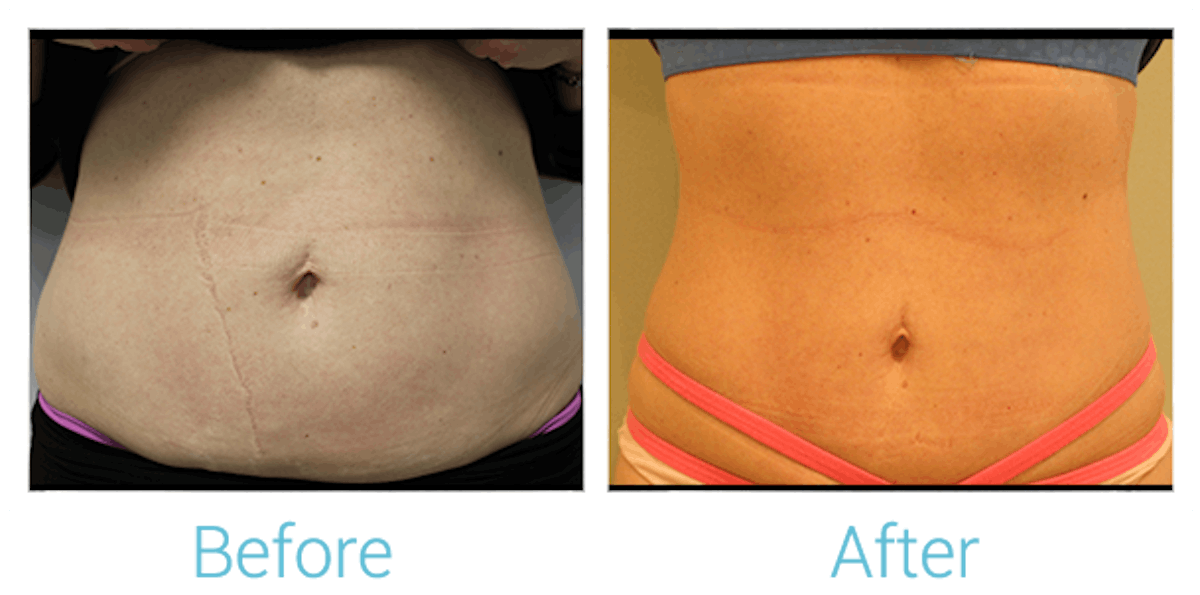 Morpheus8 Before & After Gallery - Patient 58152040 - Image 1