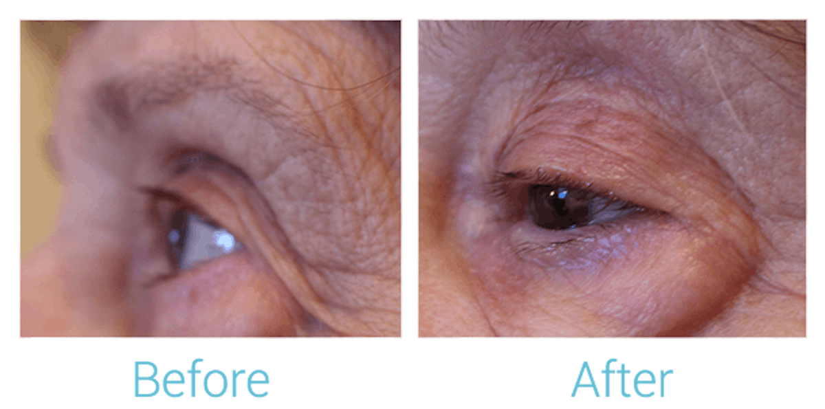 Morpheus8 Before & After Gallery - Patient 58152041 - Image 1