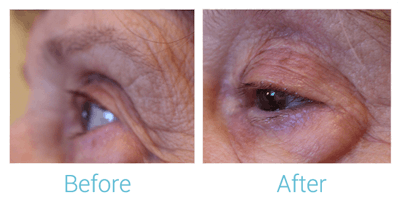 Reaction Radio Frequency Before & After Gallery - Patient 58152041 - Image 1
