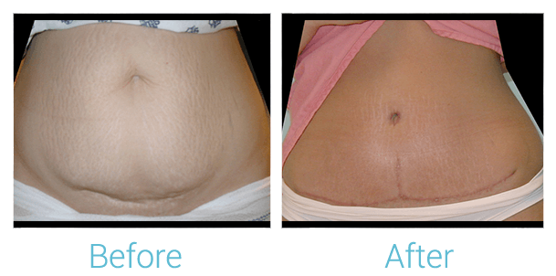 Tummy Tuck
