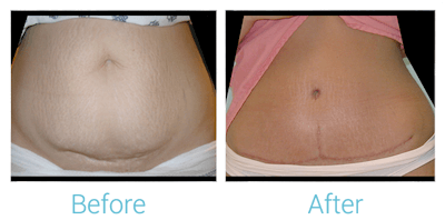 Tummy Tuck Before & After Gallery - Patient 58152050 - Image 1