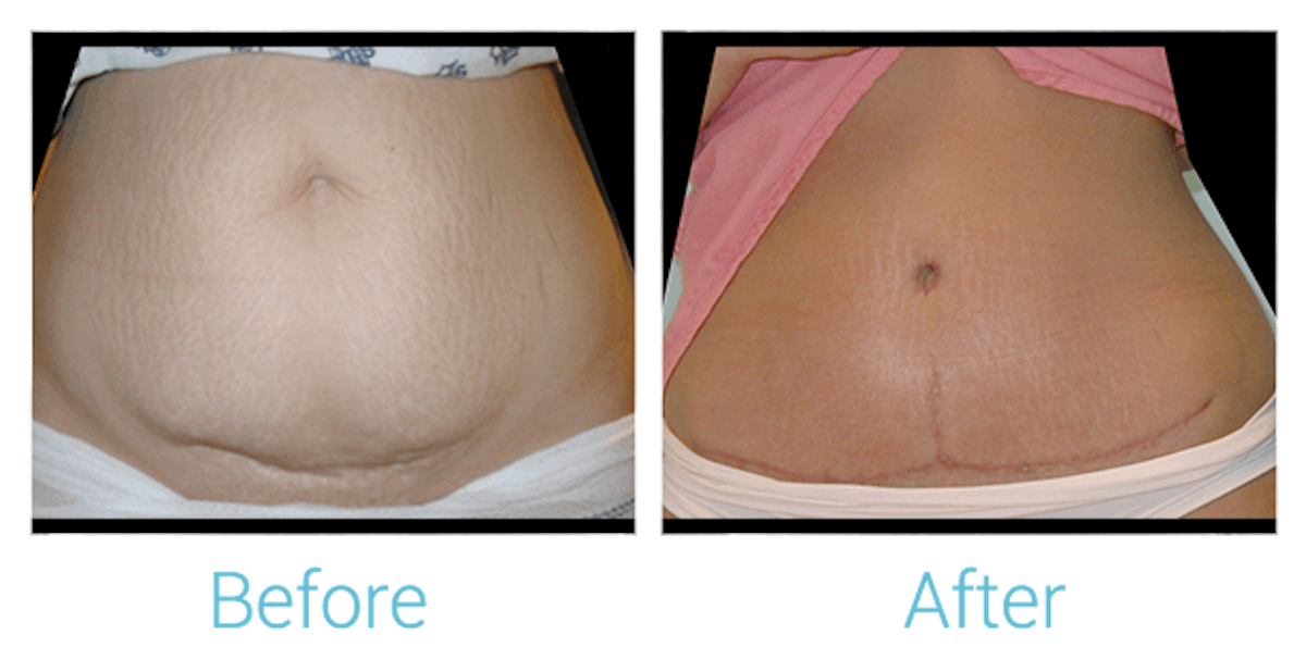 Tummy Tuck Before & After Gallery - Patient 58152050 - Image 1