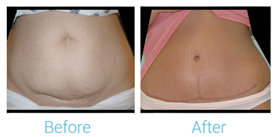 Tummy Tuck Gallery - Patient 58152050 - Image 1