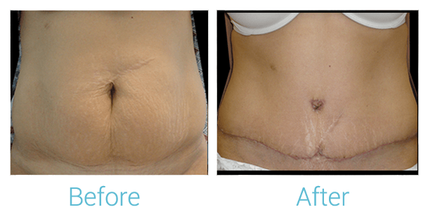 Tummy Tuck Gallery - Patient 58152051 - Image 1