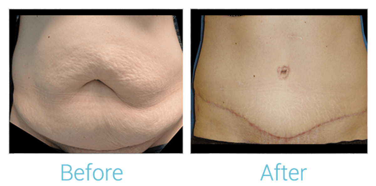 Tummy Tuck Before & After Gallery - Patient 58152052 - Image 1