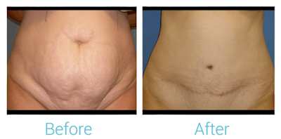 Tummy Tuck Before & After Gallery - Patient 58152053 - Image 1