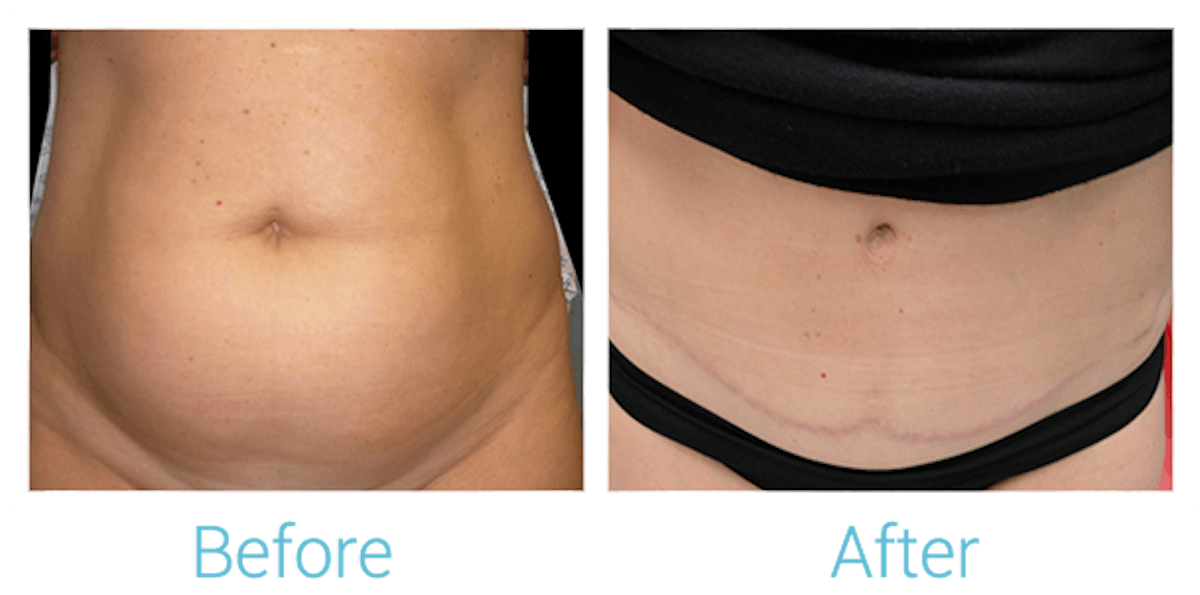 Tummy Tuck Before & After Gallery - Patient 58152054 - Image 1