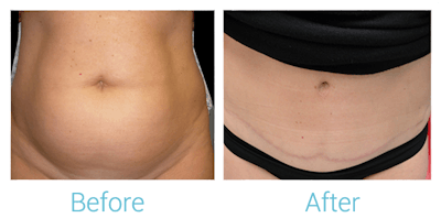 Tummy Tuck Before & After Gallery - Patient 58152054 - Image 1