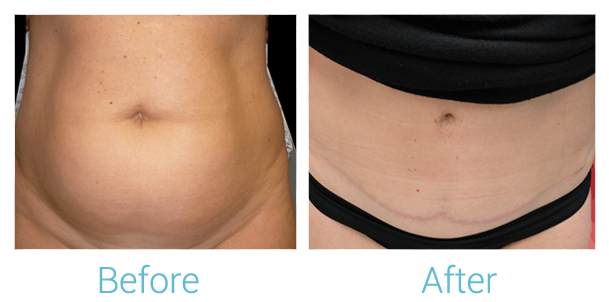 Tummy Tuck Gallery - Patient 58152054 - Image 1