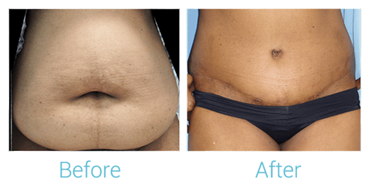 Tummy Tuck Before & After Gallery - Patient 58152055 - Image 1