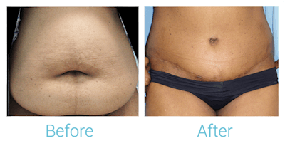 Tummy Tuck Before & After Gallery - Patient 58152055 - Image 1
