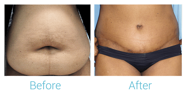 Tummy Tuck Before & After Gallery - Patient 58152055 - Image 1