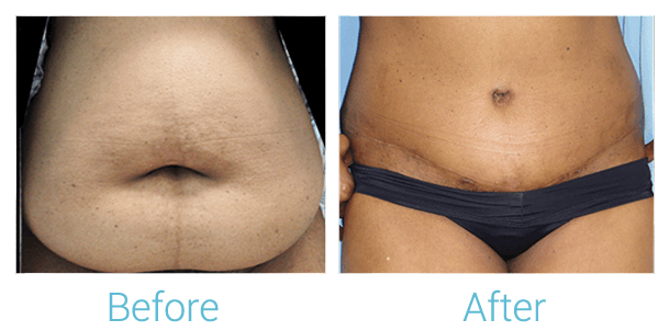Tummy Tuck Gallery - Patient 58152055 - Image 1