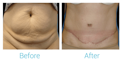 Tummy Tuck Before & After Gallery - Patient 58152060 - Image 1