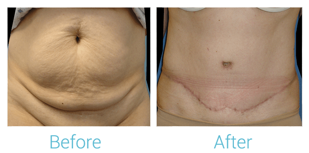 Tummy Tuck Before & After Gallery - Patient 58152060 - Image 1