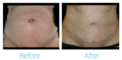Tummy Tuck Before & After Gallery - Patient 58152061 - Image 1