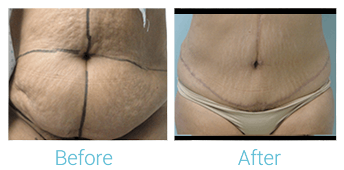 Tummy Tuck Before & After Gallery - Patient 58152062 - Image 1