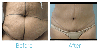 Tummy Tuck Before & After Gallery - Patient 58152062 - Image 1